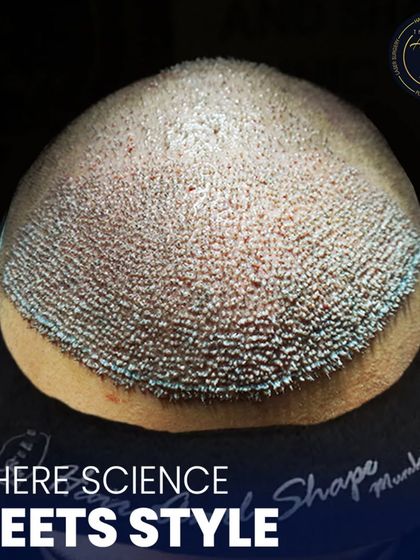This is where science meets style. A detailed view of newly implanted hair follicles, showcasing the meticulous process of high-density hair restoration.