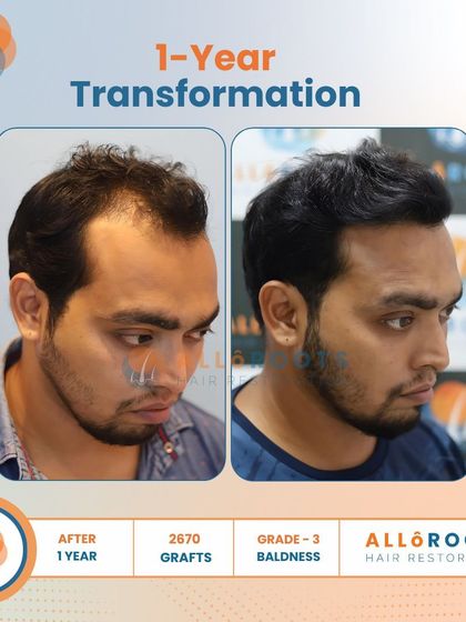 After one year, this patient's Grade 3 baldness was fully addressed with 2670 grafts. The transformation is evident in his smile and the natural, dense hairline that frames his face.