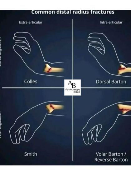 An overview of common distal radius (wrist) fractures, such as Colles and Smith fractures. Post-cast physiotherapy is crucial for restoring full wrist motion and strength.
