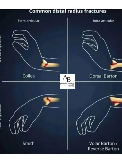 An overview of common distal radius (wrist) fractures, such as Colles and Smith fractures. Post-cast physiotherapy is crucial for restoring full wrist motion and strength.