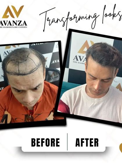 This image shows the pre-operative markings for hairline restoration and the impressive final result. We successfully addressed both the receding hairline and thinning on top.