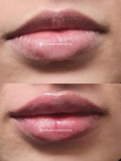 A beautiful example of how lip fillers can create a fuller, more symmetrical pout while maintaining a natural look and feel.