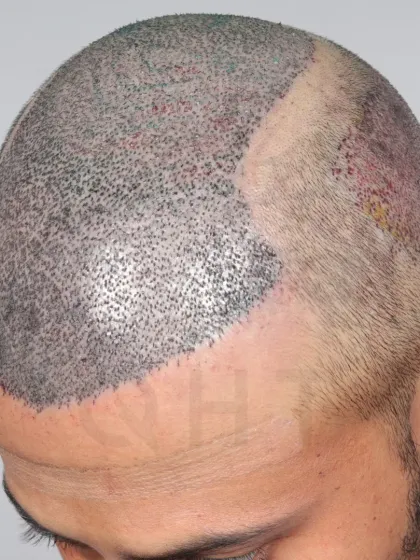 A look at the graft placement for a Norwood Grade 6 case. 5400 grafts were used to recreate the hairline, frontal part, mid-scalp, and crown.