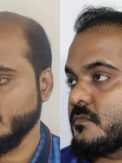From the side, you can see the extent of the restoration, covering the frontal and mid-scalp regions effectively.
