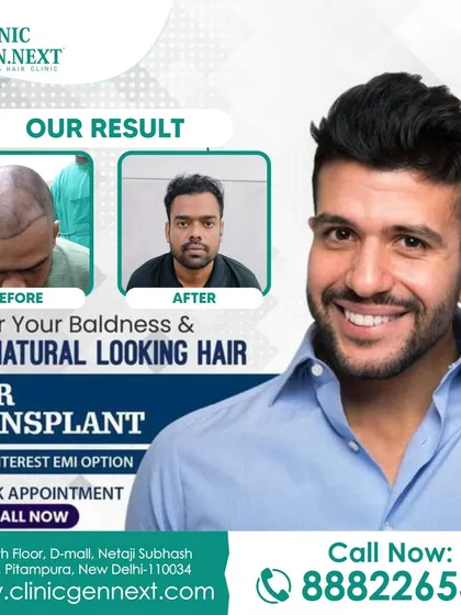Here is another example of a patient's journey, covering his baldness and achieving natural-looking hair through my FUE hair transplant technique.