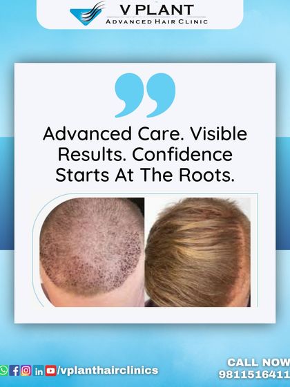 Advanced care leads to visible results. This before-and-after image shows the transition from a post-operative scalp to healthy, growing hair, proving that confidence starts at the roots.