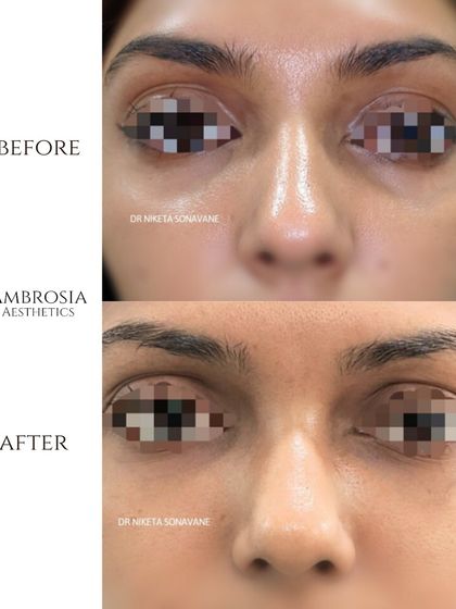 This patient was concerned about tired-looking eyes. A combination of treatments, including under-eye fillers, helped to smooth the transition from the cheek to the eye area, creating a refreshed and brighter appearance.