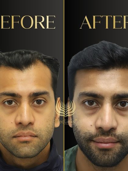 This before and after comparison shows a dramatic improvement in hair density and hairline. The patient looks younger and more confident.