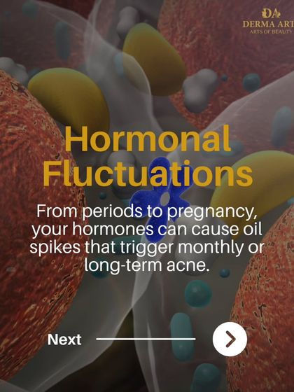 This graphic illustrates how hormonal fluctuations, from periods to pregnancy, can cause oil spikes that trigger monthly or long-term acne.
