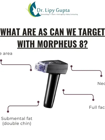 Morpheus8 is incredibly versatile. This image shows the different areas we can target, including the delicate eye area, the full face, the neck, and submental fat, which is commonly known as a double chin.