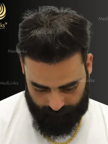 A top-down view of the final result, showing the excellent coverage and density achieved with our Perfect-i technique.