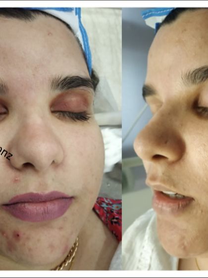 From active breakouts around the mouth and chin to a much clearer complexion, this image highlights the effectiveness of a targeted acne treatment plan.