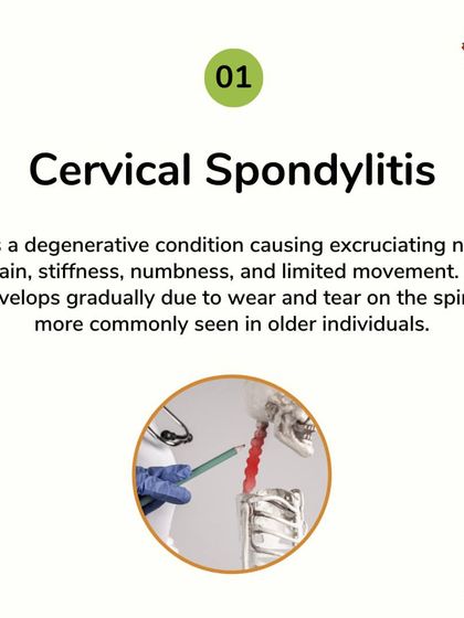 Cervical Spondylitis causes debilitating neck pain and stiffness. My treatments focus on addressing this degenerative condition to reduce pain and improve movement, offering a natural alternative for managing this common ailment.
