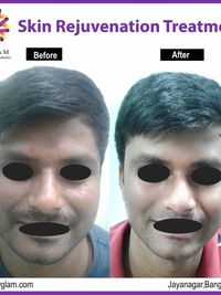 Facial Anti-Aging & Rejuvenation