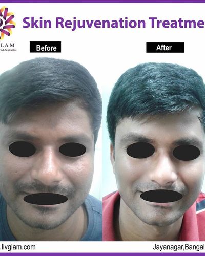 Facial Anti-Aging & Rejuvenation