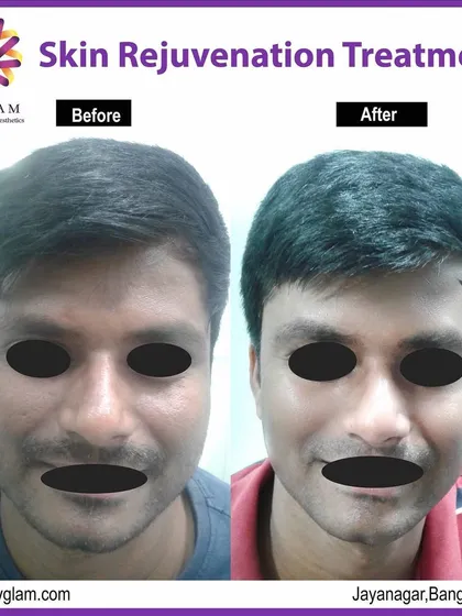 This male client received a skin rejuvenation treatment to address uneven skin tone and texture. The result is visibly clearer, smoother skin, showing that these treatments are highly effective for men as well.