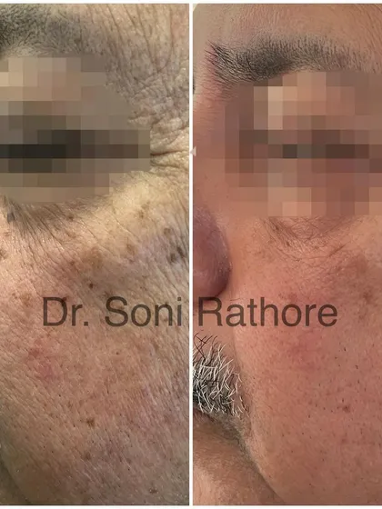 This image shows the result after just one session of laser treatment for sun spots and uneven pigmentation. The laser targets and breaks down the excess melanin, leading to a clearer, more even complexion.