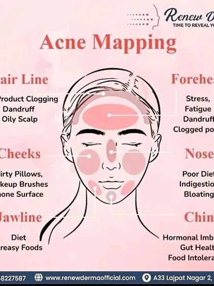 This acne face map helps identify potential underlying causes of breakouts based on their location, from stress-related forehead acne to hormonal chin acne.