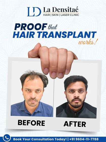 When Uddhav chose my clinic, he was choosing expertise. This before-and-after photo shows what that decision can achieve. With advanced techniques and careful planning, I create natural hairlines and results that last.