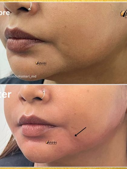 Here we corrected a bulky jawline and droopy mouth corners. This treatment helps to slim the lower face and lift the corners of the mouth, resulting in a more defined and pleasant expression.