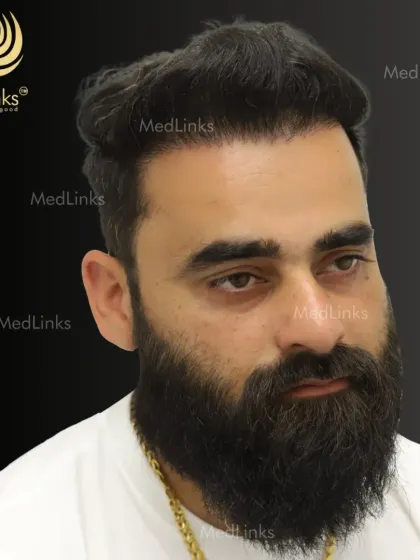 The final result, with a full and natural-looking head of hair. The patient can now style his hair with confidence.