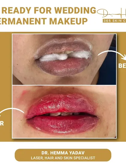Here you can see the immediate result of a permanent lip blush procedure. We corrected uneven pigmentation and added a healthy, natural color, which is perfect for an effortless look, especially for big events like a wedding.