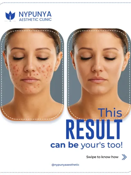 This is a result that can be yours. This before and after showcases the power of laser resurfacing for treating acne scarring and uneven texture. The treatment works by removing damaged outer skin layers and stimulating new collagen, resulting in smoother, clearer skin. This kind of transformation is possible with a targeted, professional treatment plan.