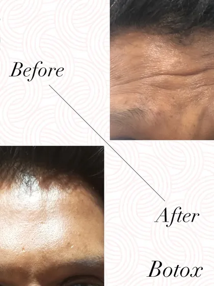This is a great demonstration of how Botox can smooth deep-set forehead lines. My technique ensures you look refreshed and rested, not frozen, so you can still make natural expressions.