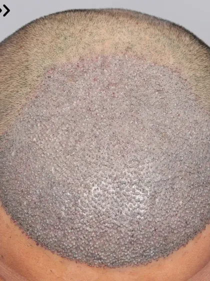 The start of a journey for a Diffuse Grade 4A patient. 3500 grafts were used to recreate the hairline, frontal zone, and mid-scalp.