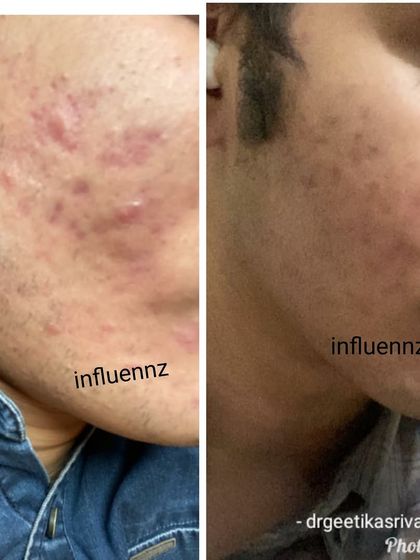 This client's journey shows the successful management of inflammatory acne on the cheek and jawline, resulting in significantly clearer skin.