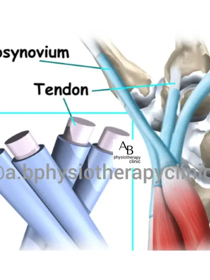 This image shows the tenosynovium, the sheath that surrounds the tendons. In conditions like tendonitis, this sheath becomes inflamed, causing pain and a grinding sensation.
