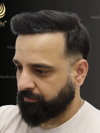 A side profile of the final result. The hairline is designed to be age-appropriate and natural, ensuring the transplant remains undetectable for years to come.