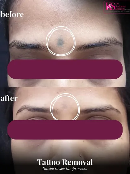 Here you can see the significant fading of a facial tattoo after a course of laser tattoo removal sessions. My approach focuses on gradually breaking down the ink pigment with each treatment, allowing the body to clear it naturally. This ensures the skin's integrity is protected while achieving clear, impressive results.