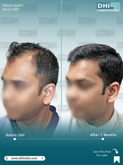 A side-view comparison of the same client's 7-month progress. This angle highlights the natural-looking hairline and the seamless blend of the transplanted hair, demonstrating the artistry of our surgeons.