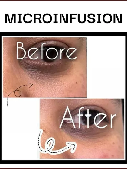 Microinfusion is highly effective for the delicate under-eye area. This before-and-after shows a significant improvement in dark circles, helping my client look more refreshed and rejuvenated.
