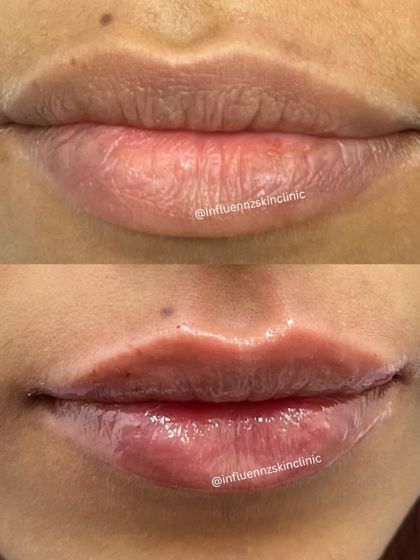 This close-up before and after highlights the improvement in lip texture and volume, resulting in a hydrated and youthful appearance.