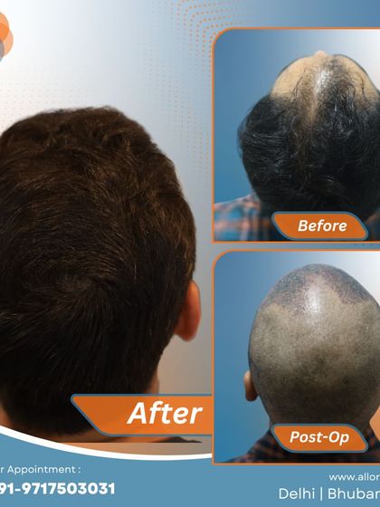 This series shows the complete process for a patient, from the before and post-op stages to the final impressive result. It gives a comprehensive view of the transformation journey.