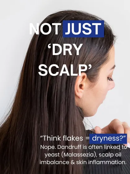 A key fact about dandruff is that it is not just a 'dry scalp'. It is most often linked to an imbalance of yeast on the scalp (Malassezia) and inflammation, which is why it requires targeted medical treatment.