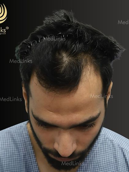 A top-down view of the patient's hair loss before the transplant.
