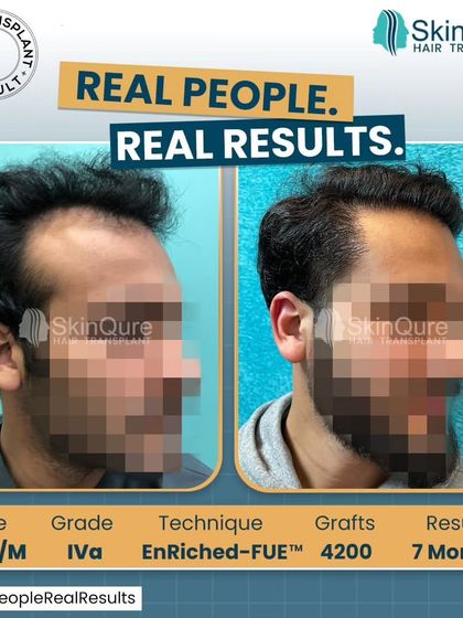 A side-profile view of the 23-year-old patient with Grade IVa hair loss. The 7-month result after 4200 grafts shows a remarkable transformation with a dense and natural-looking hairline.
