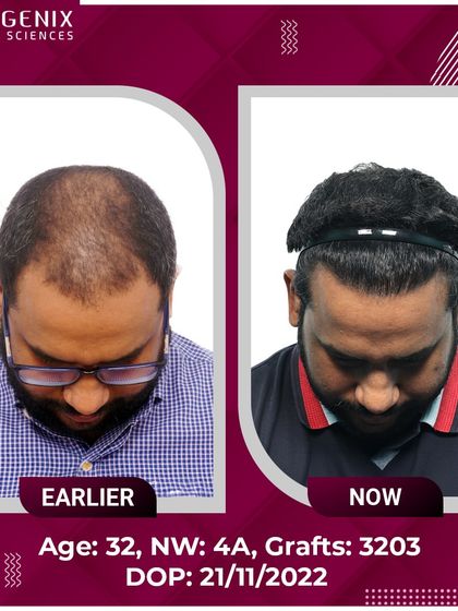 The top choice for natural restoration, this 32-year-old's Grade 4A hair loss was treated with 3203 grafts.