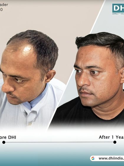 Another side-profile view of the one-year result. This image highlights the expertly crafted hairline that frames his face perfectly, showcasing the artistic skill of our DHI surgeons.