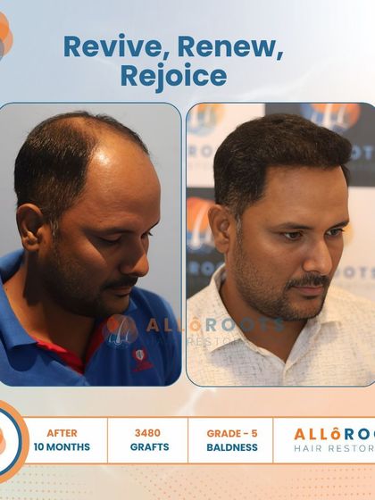 Revive, Renew, Rejoice. This 10-month result for a Grade 5 baldness case, using 3480 grafts, shows a complete restoration. The images from all angles prove that a full head of hair is an achievable goal.