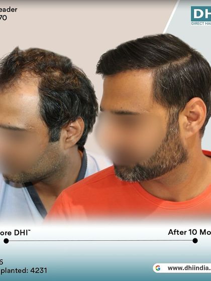 A side-profile view of the same client's 10-month transformation. The restored hairline and temple points create a sharp, defined look, showcasing the artistic precision of our DHI surgeons.