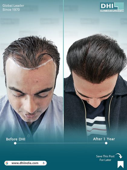 A top-down view of the one-year result. This image shows the excellent coverage achieved across the scalp, a testament to the effectiveness of the DHI Direct Hair Implantation technique.