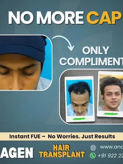 It's time to trade the cap for compliments. This patient's journey is a perfect example of how our Instant FUE technique can restore not just a hairline, but the confidence to face the world without hiding.