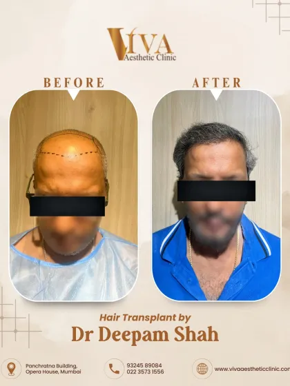 For advanced hair loss like this, we performed a full scalp restoration with 7500 grafts. This before-and-after shows the frontal view, where we rebuilt the entire hairline and frontal zone.
