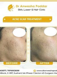Acne & Acne Scar Treatment
