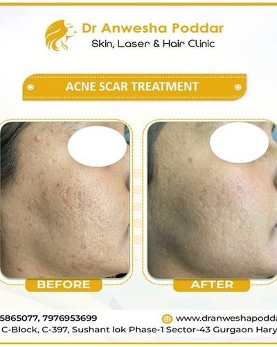 Acne & Acne Scar Treatment