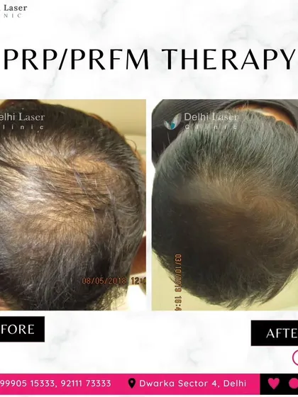 Here you can see the clear difference PRP and PRFM therapy can make. This patient's scalp was visibly thinning, and after a customized treatment plan, his hair is significantly denser and healthier. This is a non-surgical way to fight hair loss.